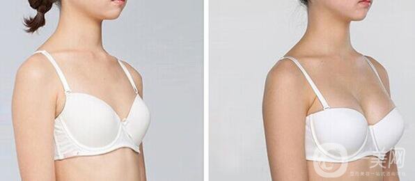 上海自體脂肪隆胸多少錢