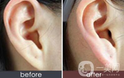 北京自體脂肪豐耳垂大概收費價格是多少