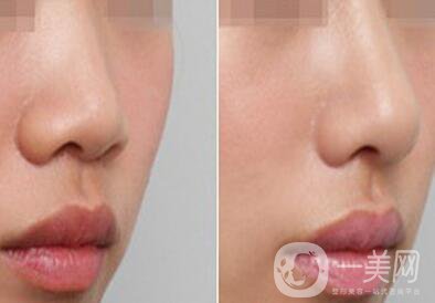 上海自軟體隆鼻多少錢