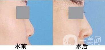 上海駝峰鼻矯正價(jià)錢(qián)