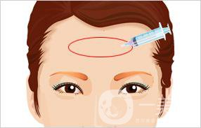 深圳自體脂肪豐額頭手術大概多少錢
