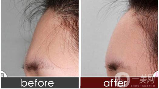 深圳自體脂肪豐額頭手術大概多少錢