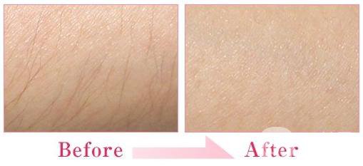 北京做冰點脫毛收費情況 價格介紹