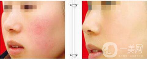 激光去黃褐斑術(shù)后護(hù)理