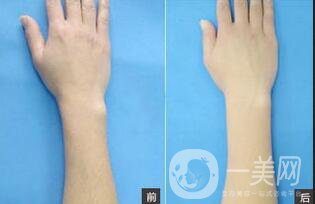 上海光子脫毛多少錢(qián)