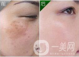 激光去黃褐斑*果
