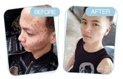 像素激光祛痘坑術后護理工作主要做些什么