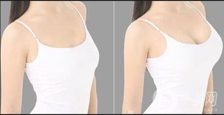 上海隆胸價(jià)格