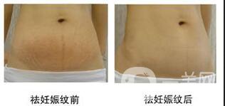 去妊娠紋價格