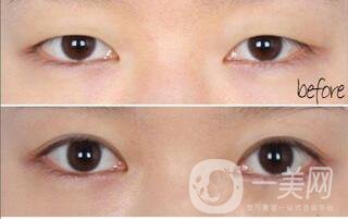 割雙眼皮術后護理