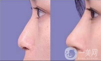 鼻翼縮小費用,鼻翼縮小多少錢