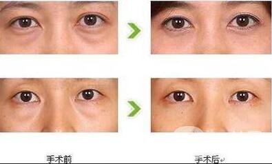 外切去眼袋修復價格