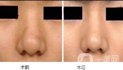 鼻翼縮小價(jià)格