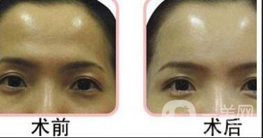 膠原蛋白豐額頭報(bào)價(jià)