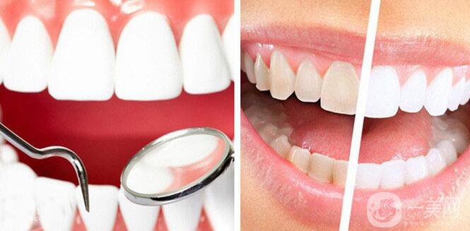 超聲波洗牙原理