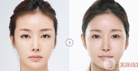 頭發(fā)種植,頭發(fā)種植術(shù)后護理