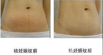 去妊娠紋價(jià)格多少錢(qián)