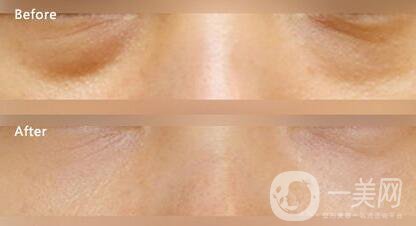 溶脂去眼袋修復價格