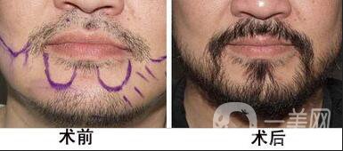 胡須種植,胡須種植*果