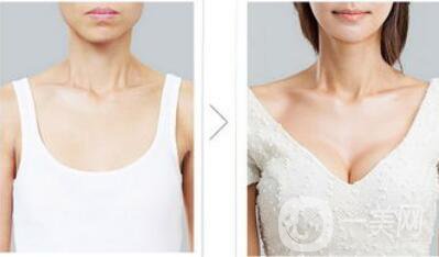 脂肪隆胸整形手術(shù)價格