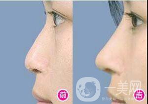 假體隆鼻整形價(jià)格