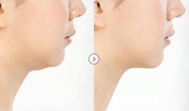 去雙下巴報(bào)價(jià)