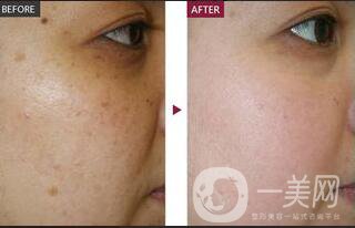 祛斑價(jià)錢,激光祛斑價(jià)格