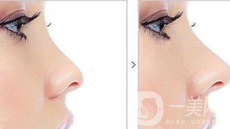 玻尿酸隆鼻多少錢(qián)