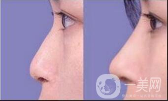 鼻翼縮小手術(shù)價格,鼻翼縮小