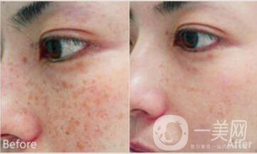 祛斑價(jià)位