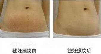 去妊娠紋價格
