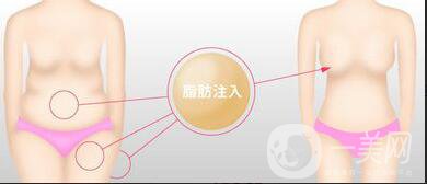 吸脂隆胸整形手術(shù)價格