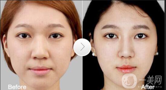 鼻翼縮小手術(shù)價格