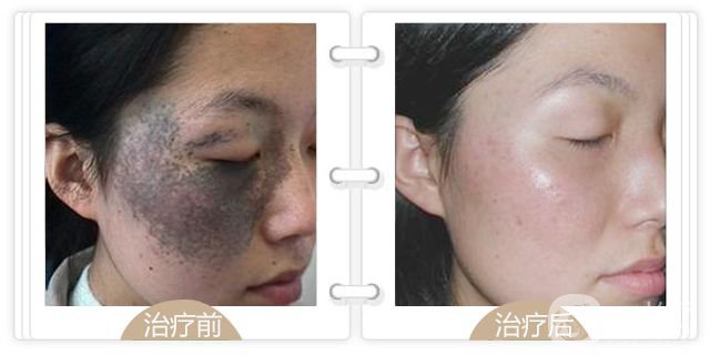 上海去青色胎記多少錢