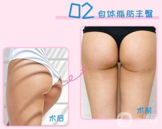 上海自體脂肪填屁股多少錢