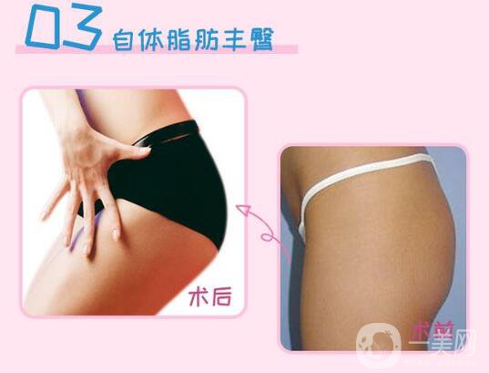 上海自體脂肪填屁股多少錢