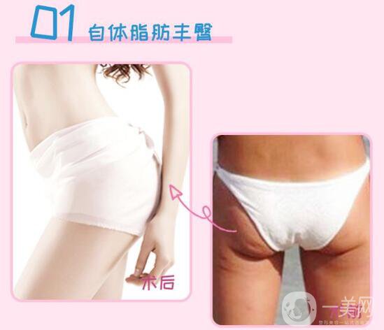 上海自體脂肪填屁股多少錢