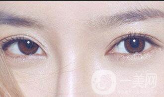 西安開眼角手術(shù)價格,開眼角價格