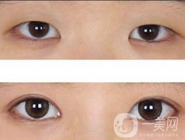 西安開眼角手術(shù)價格,開眼角價格