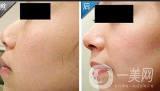 駝峰鼻矯正注意事項