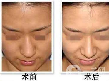 歪鼻矯正恢復(fù)時間