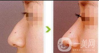 鷹鉤鼻矯正注意事項(xiàng)