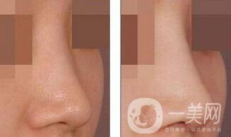 雙美膠原蛋白注射隆鼻*果,雙美膠原蛋白注射隆鼻圖