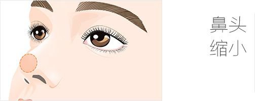 鼻頭縮小術注意事項