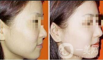 光子嫩膚優(yōu)勢