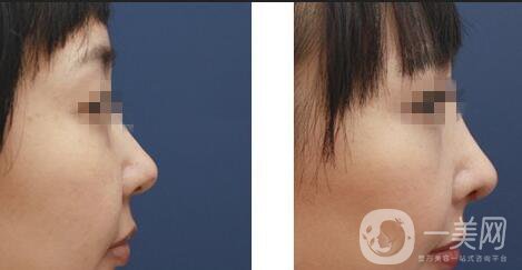 自體軟骨隆鼻術(shù)價(jià)位