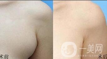 去副乳整形手術(shù)價(jià)格