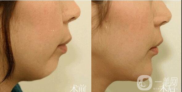 自體骨墊下巴報價