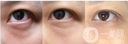 激光去黑眼圈修復(fù)價格 