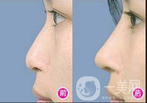 隆鼻多少錢(qián)